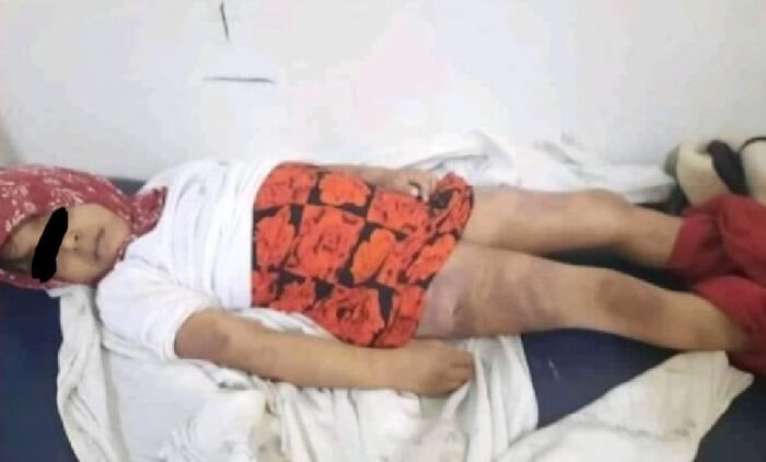 وفاة طفلة تعذيباً على يد زوجة أبيها في إب